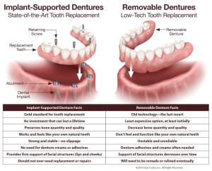 implant-supported-dentures-vs-removable