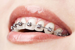 Braces(2)