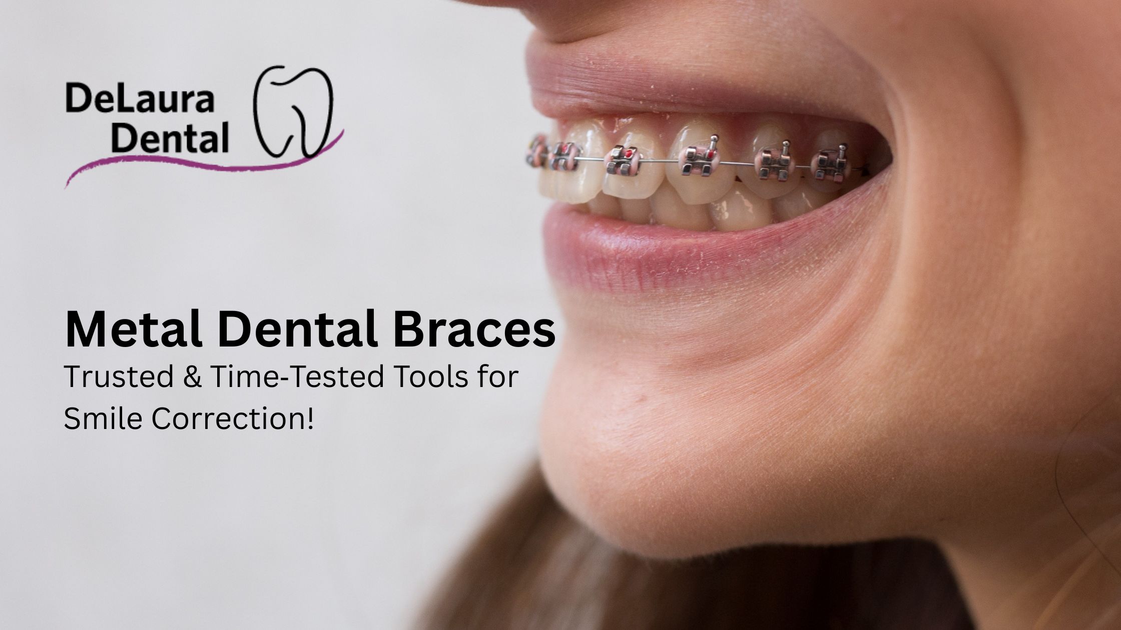 Metal dental braces